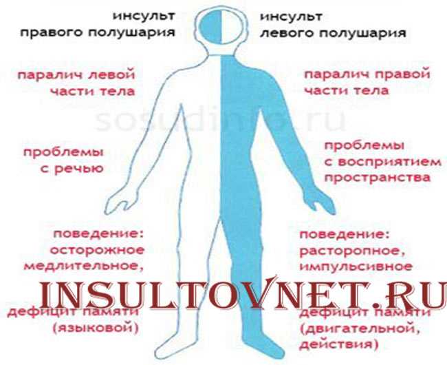 Как жить после инсульта