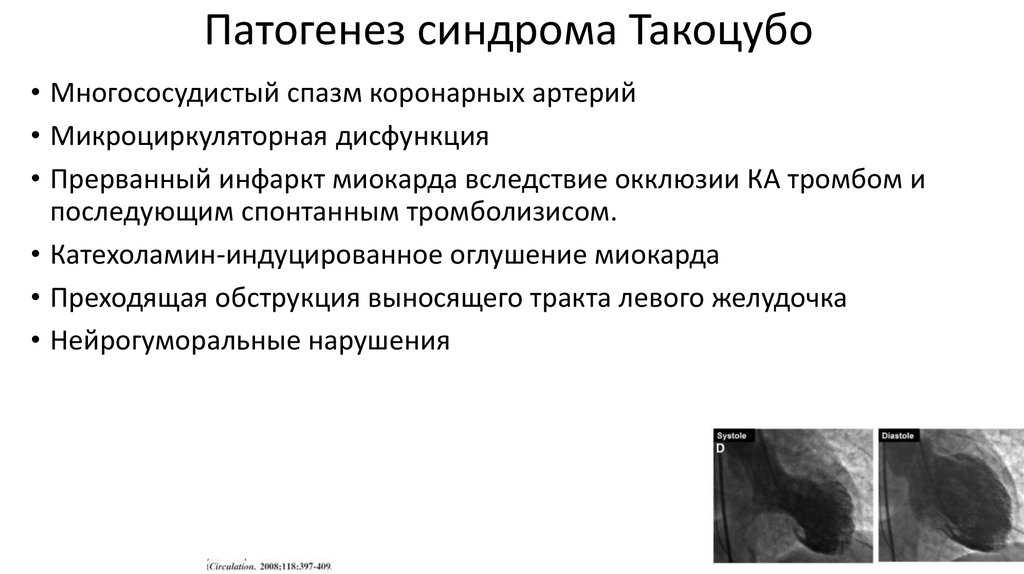 Кардиомиопатия — симптомы, причины, лечение и диагностика