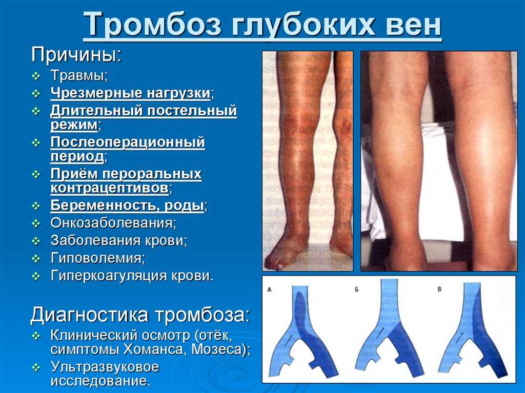 Тромбофлебит: причины, симптомы и лечение воспаления и тромбоза поверхностных вен