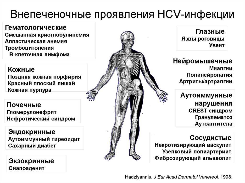 Вич: первые симптомы, стадии и развитие заболевания