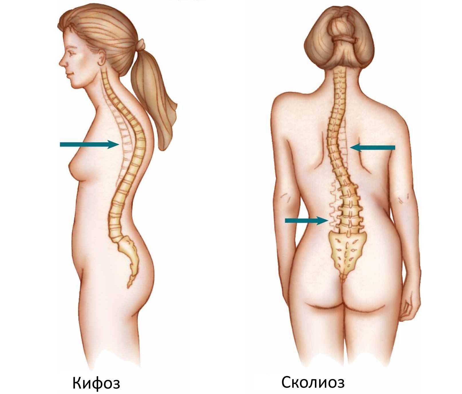 Как облегчить боль в спине при сколиозе - wikihow