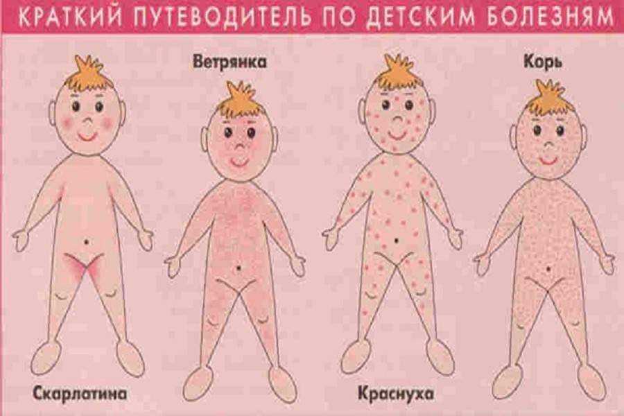 Розеола детская: как лечить болезнь