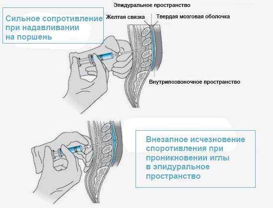 Обезболивание при кесаревом: какие есть варианты — анестезиолог