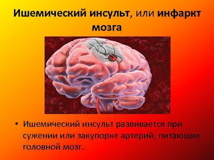 Какие прогнозы после инсульта в пожилом возрасте: