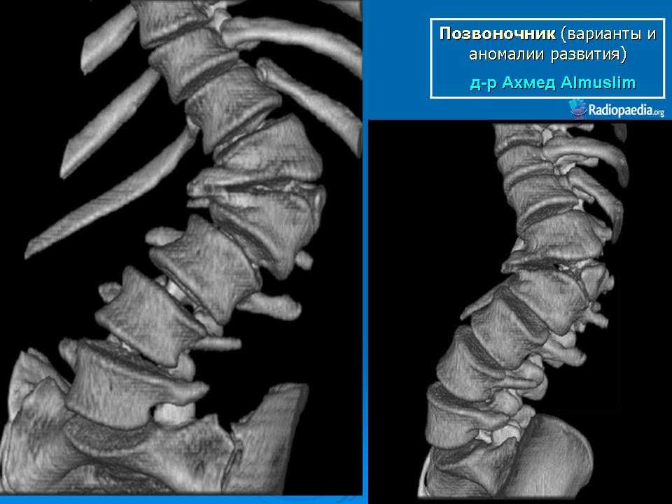 Аномалии и пороки развития позвоночника