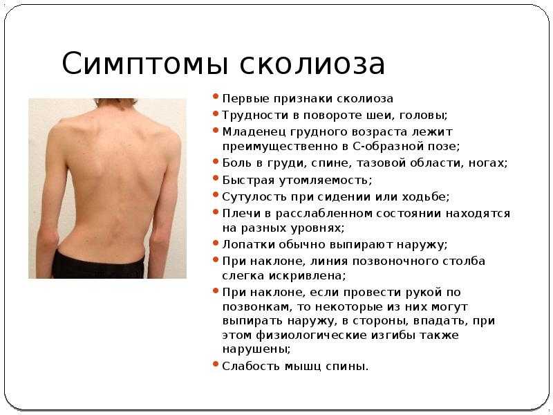 Сколиоз позвоночника - симптомы, причины, виды, степени и способы лечения