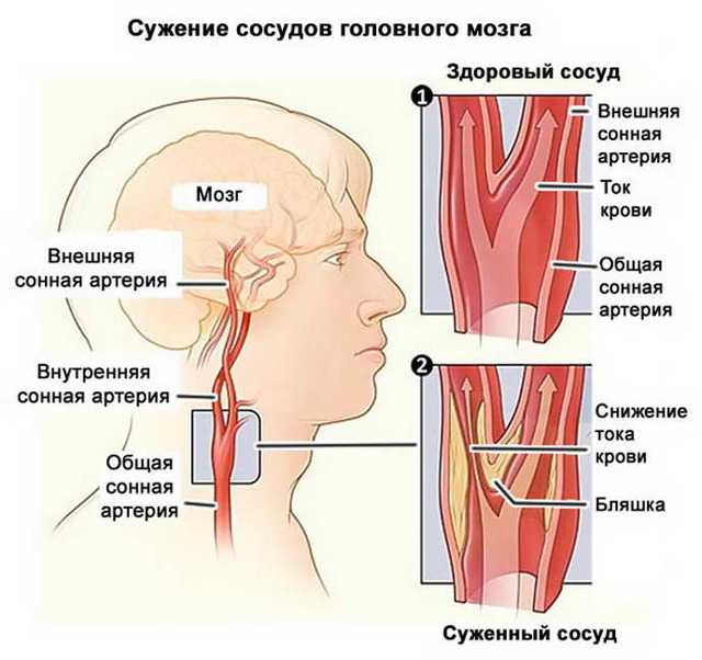 Узи сосудов: диагностика атеросклероза. выявление атеросклеротических бляшек в сосудах