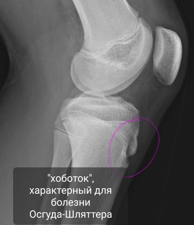 Болезнь осгуда-шлаттера