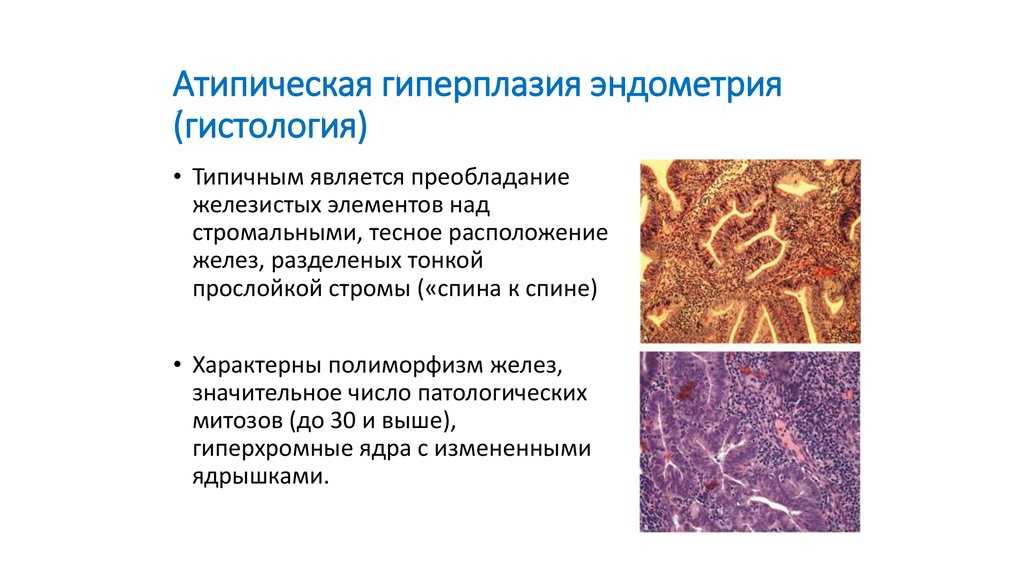 Лимфоидная гиперплазия подвздошной кишки