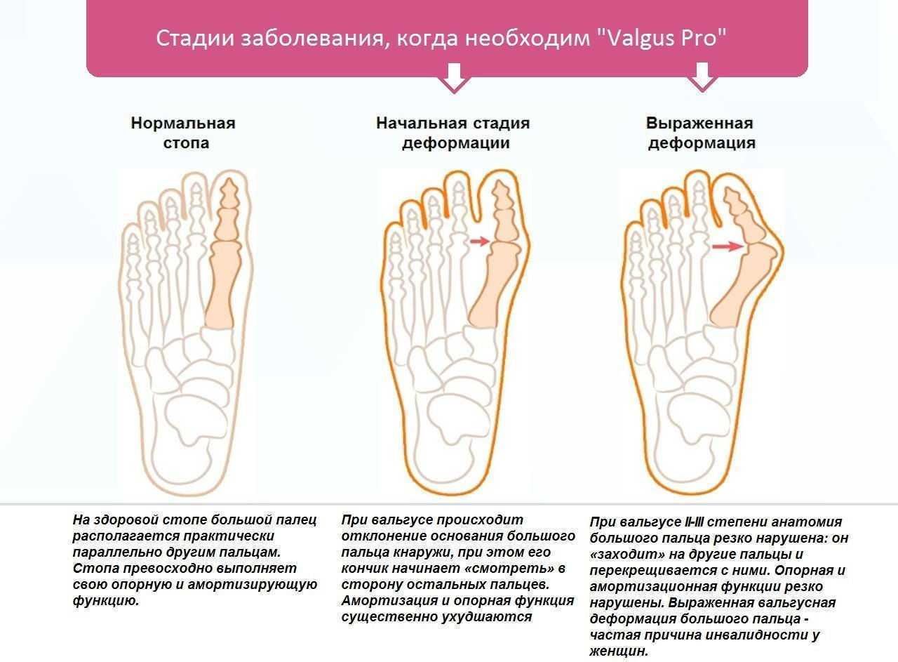 Деформация пальцев ног: разновидности, симптомы, как лечить