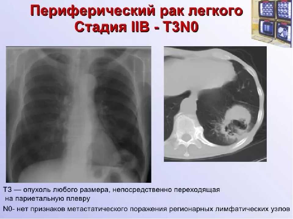 Сколько живут с раком легких и как быстро развивается рак легких. сколько живут с раком легких? жизнь после рака легкого