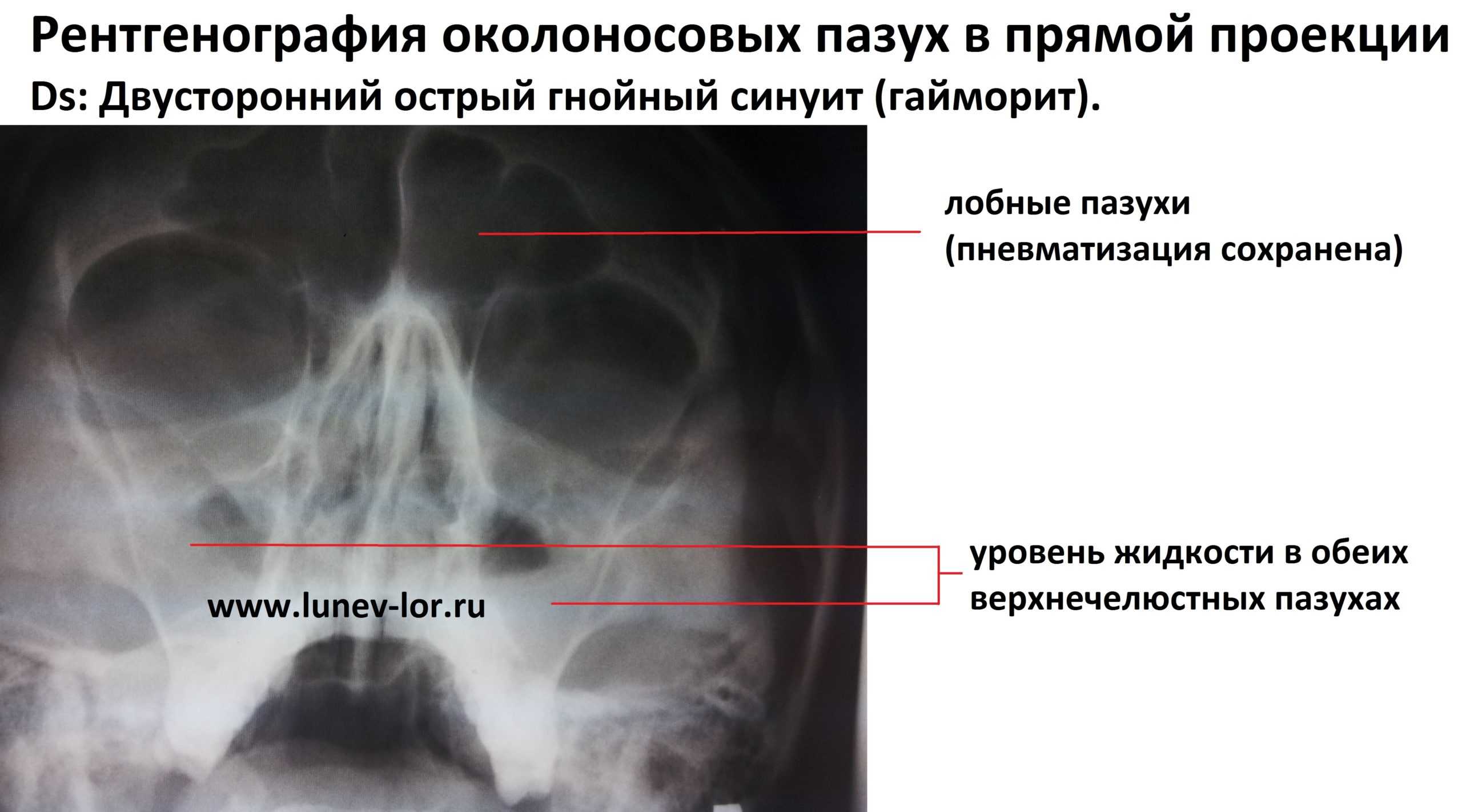 Пневматизация пазух носа: что это такое, почему они бывают пневматизированы