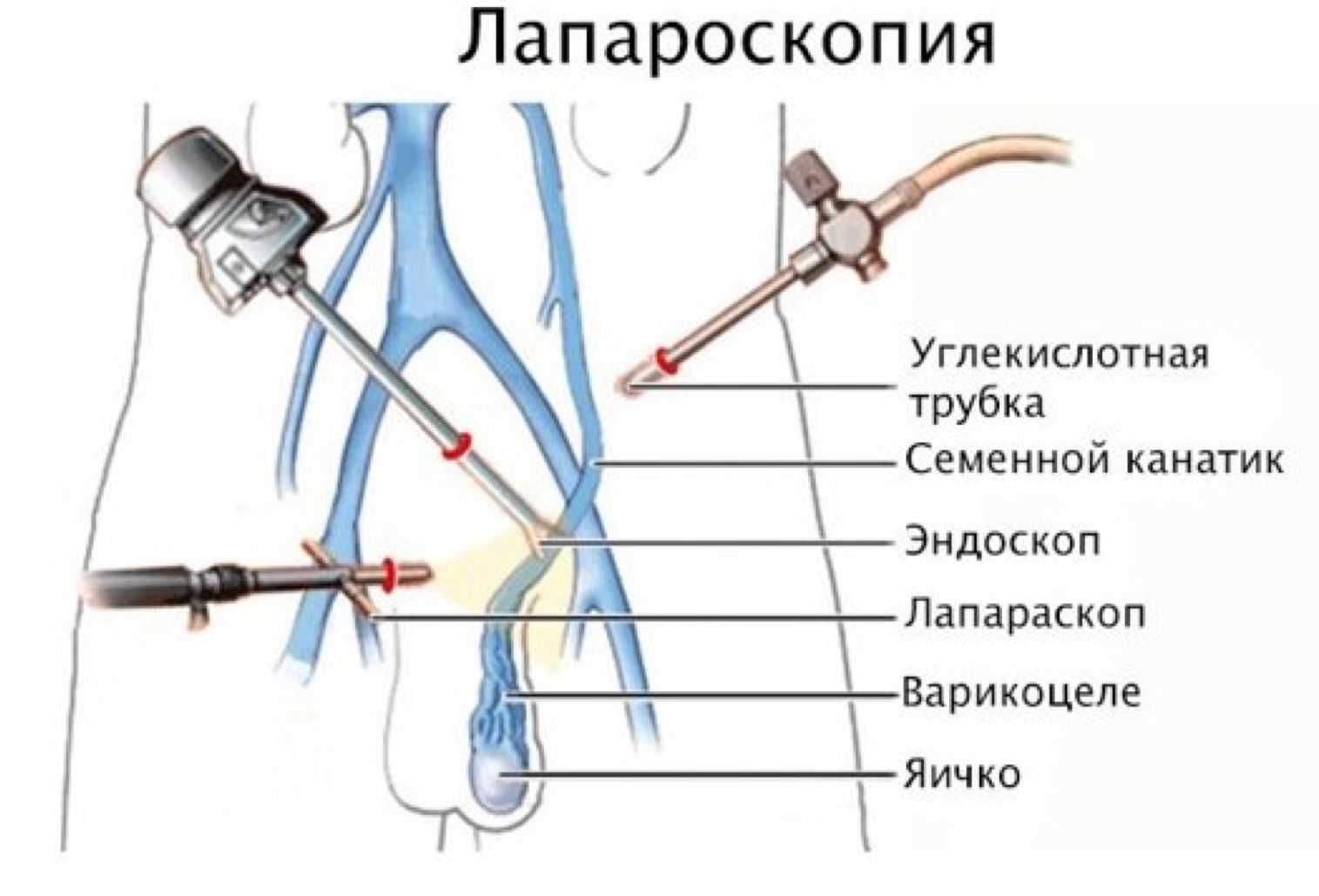 Операция варикоцеле — последствия и возможные осложнения