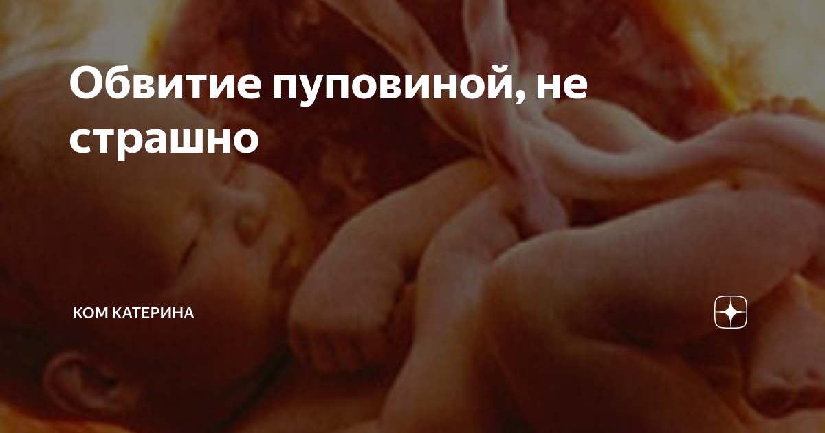 Обвитие пуповины вокруг шеи: причины, диагностика, последствия