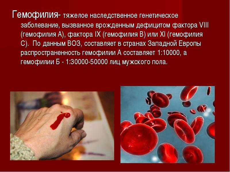 Гемофилия - лечение, причины, признаки гемофилии