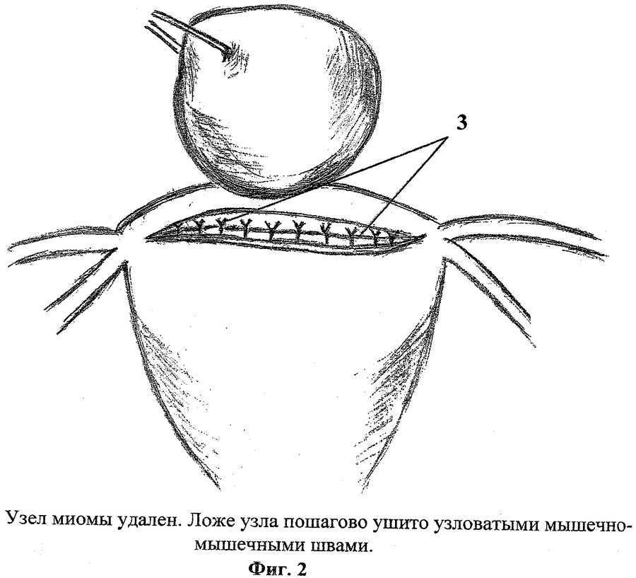 Каковы последствия удаления матки?