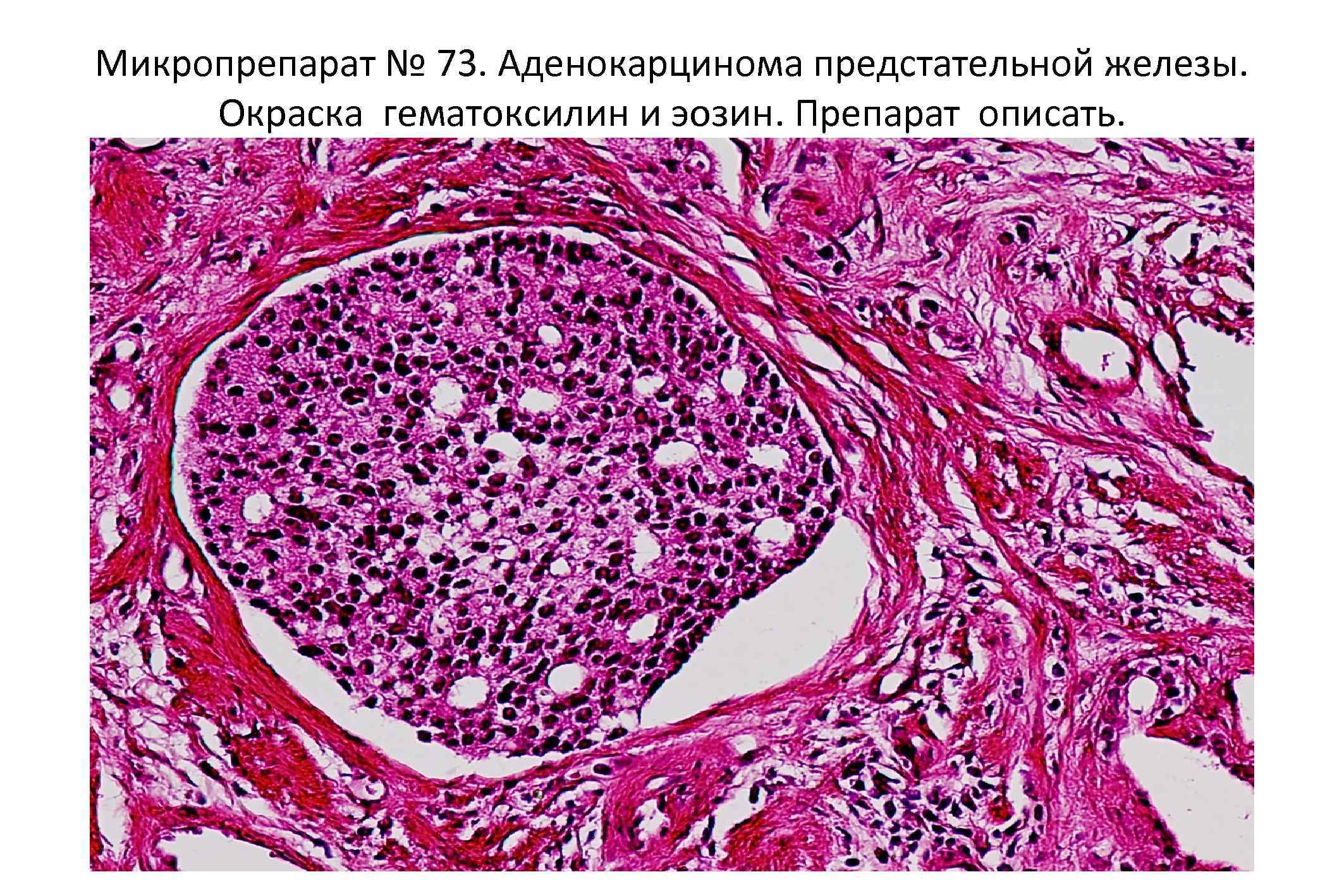 Низкодифференцированная аденокарцинома матки