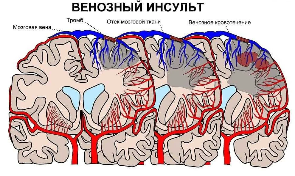 Тромбоэмболия: симптомы и признаки
