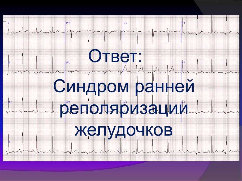 Синдром ранней реполяризации желудочков - экг, лечение, причины