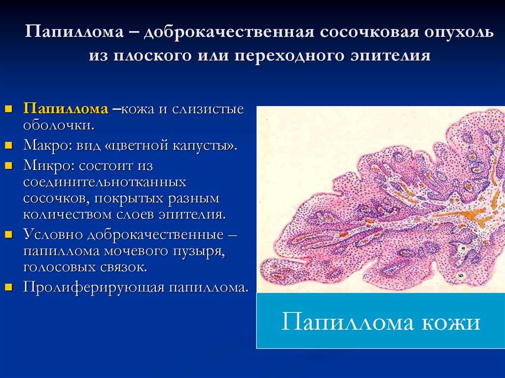 Какие виды опухолей существуют?