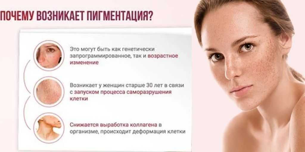 Пигментные пятна на лице: виды, причины и лечение
