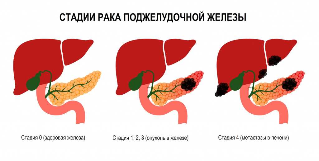 Сколько живут с раком поджелудочной железы?