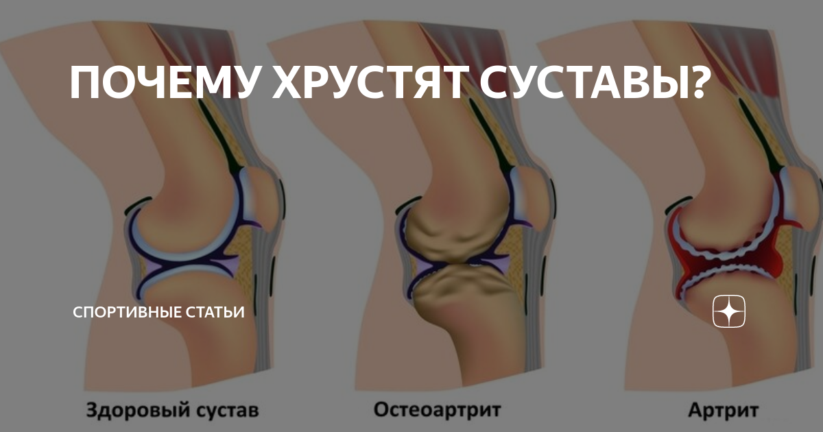 Почему у ребенка хрустят суставы