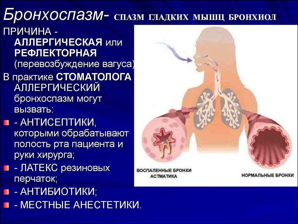 Причины и симптомы бронхоспазма у детей и взрослых  Бронхоспазм  Бронхоспазм бронхоспастический синдром – это патологическое состояние, которое возникает