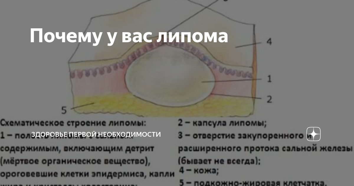 Атерома: причины, виды и симптомы/ как удалить атерому?