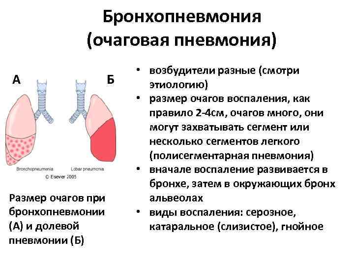 Правосторонняя пневмония у ребенка - методы лечения.