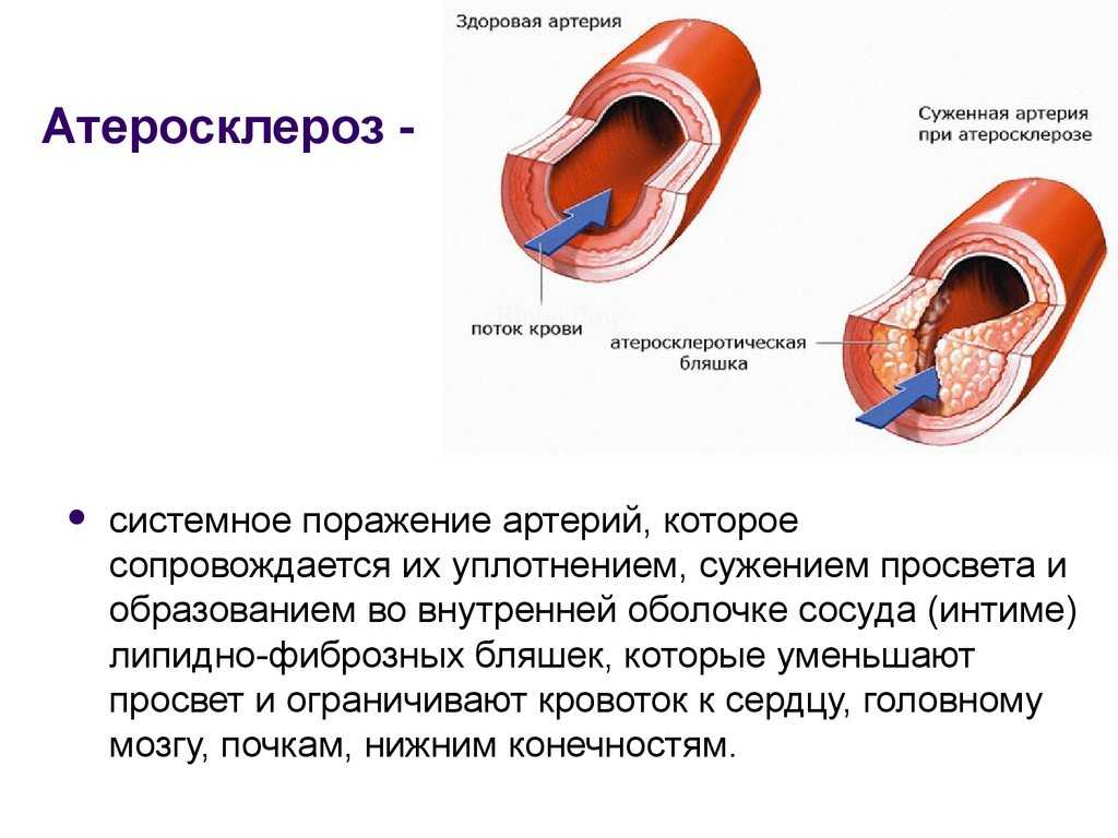 Атеросклероз