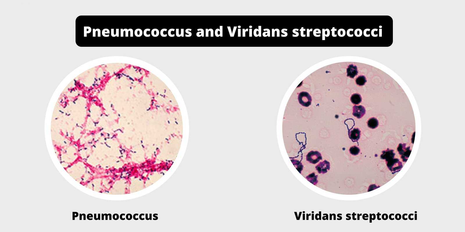 Инфекции, вызываемые streptococcus viridans (стрептококк вириданс) у взрослого - симптомы, лечение | фарингазон