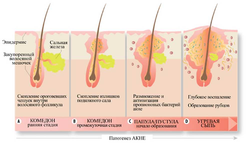 Гнойники на теле: как лечить, почему появляются на коже?