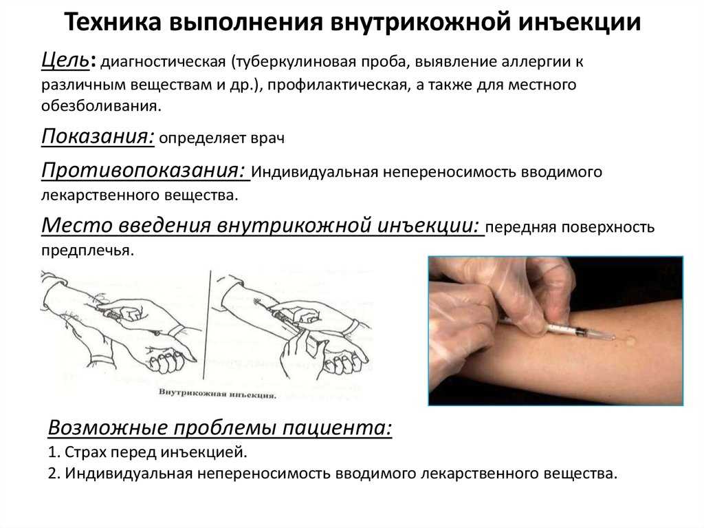 Подкожные инъекции - техника выполнения