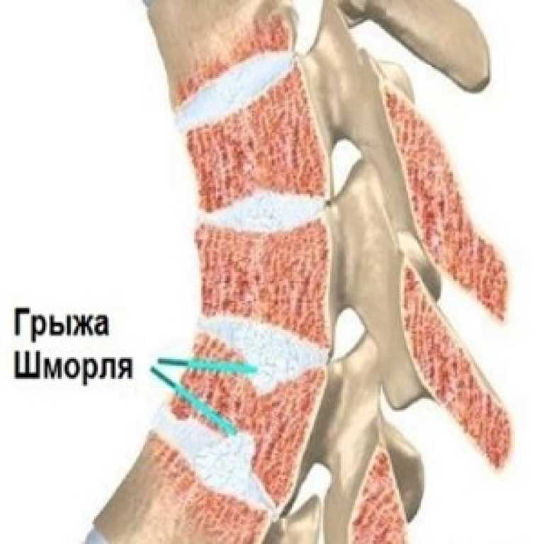 Грыжа шморля поясничного и грудного отдела