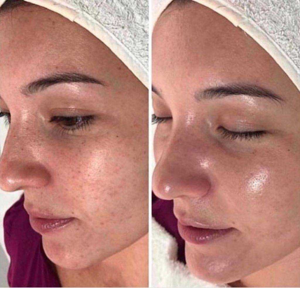 Уход за лицом после чистки| клиника roko beauty