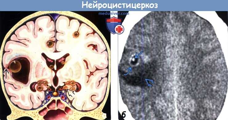 Цистицеркоз: симптомы, лечение. цистицеркоз головного мозга, глаз и других органов. фото видео