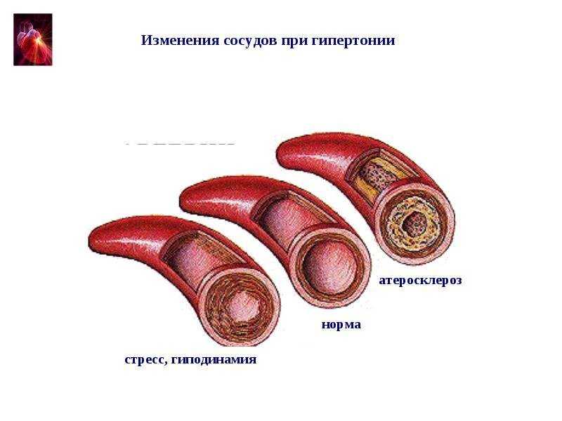 При гипотонии сосуды расширяются или сужаются > русский спорт - научная база