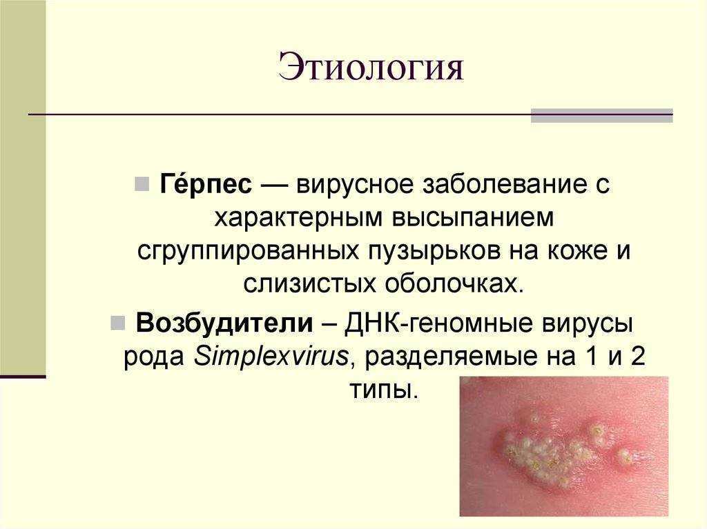 Вирусная инфекция простого герпеса при беременности