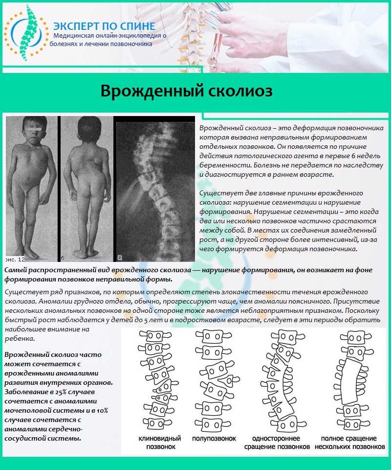 Аномалия киммерли: причины, проявления, диагностика, лечение, последствия и прогноз