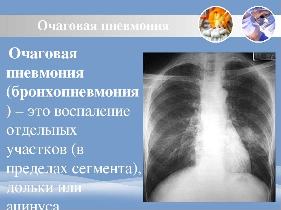 Правосторонняя пневмония у детей: признаки, диагностика, лечение
