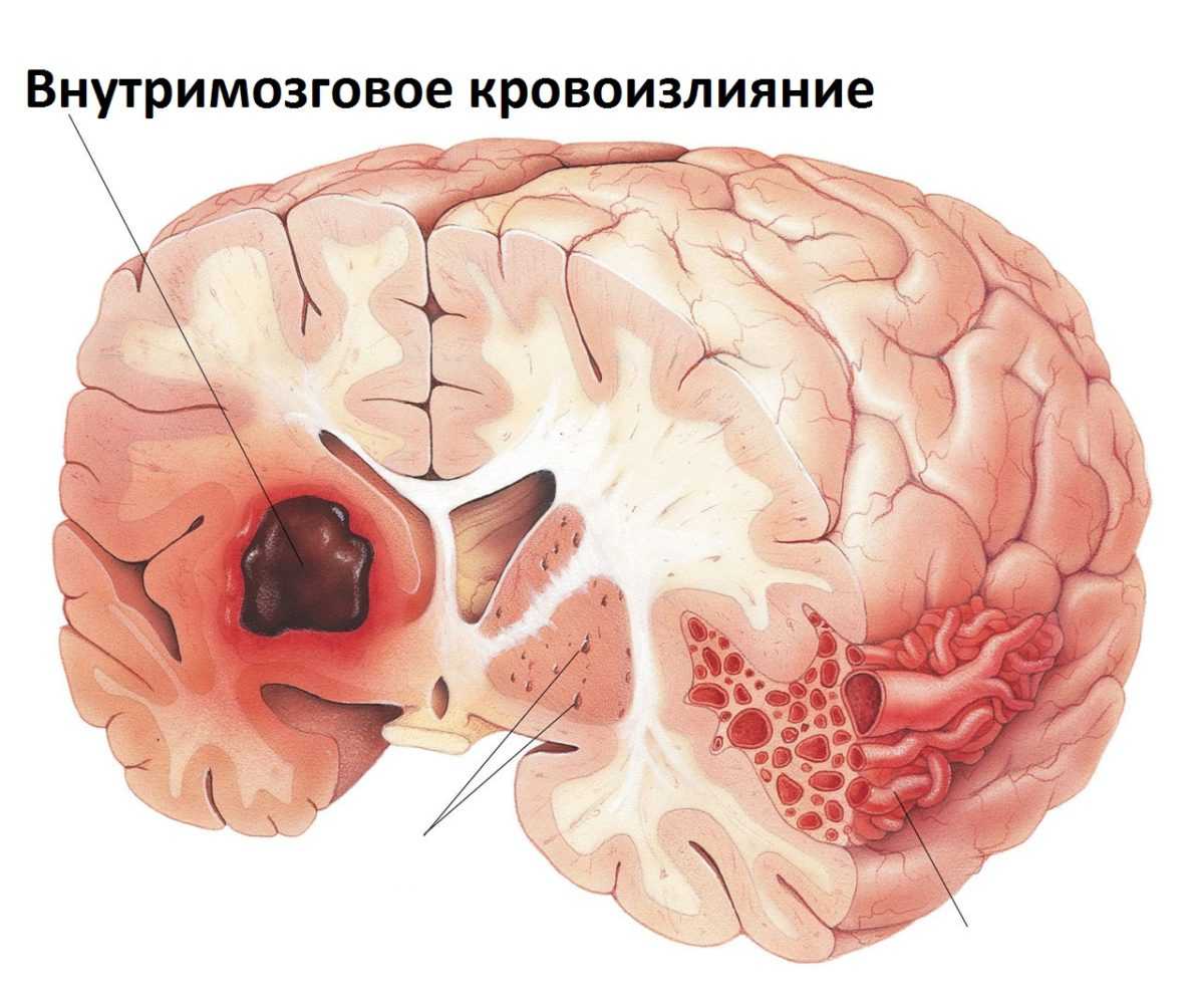 Периоды инсульта – критические дни при нарушении мозгового кровообращения | ddick.ru