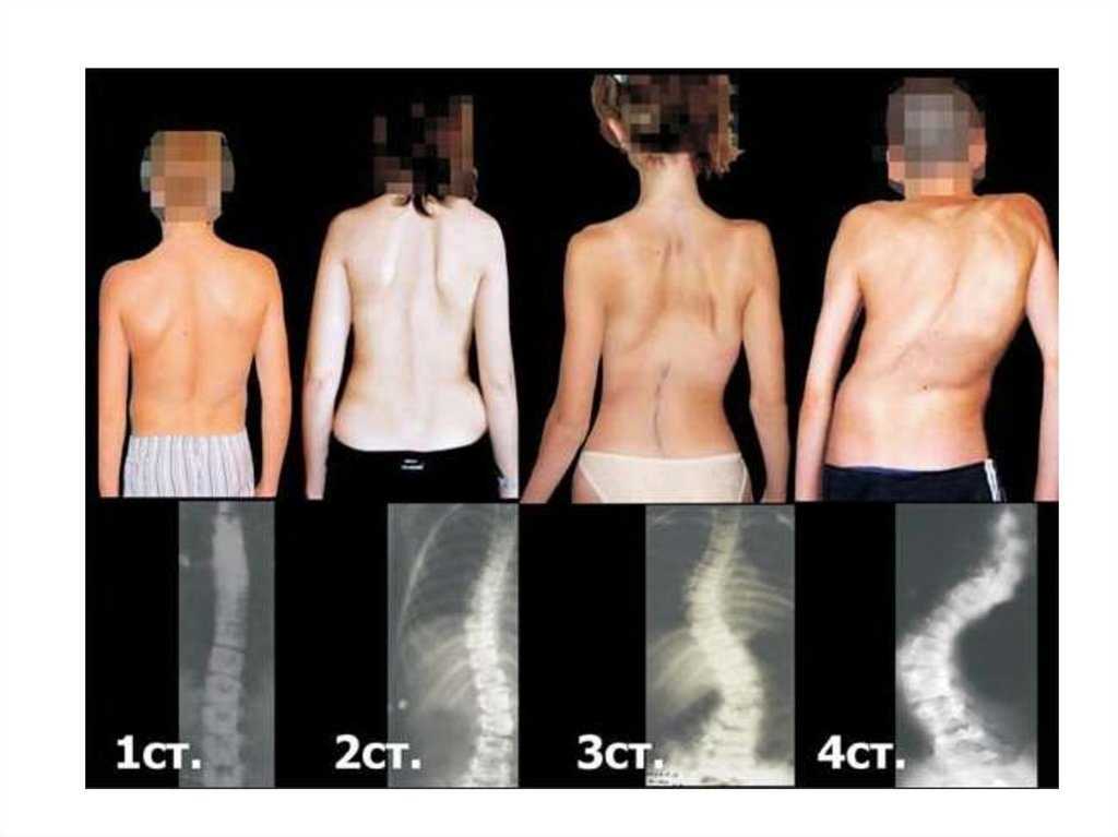 Сколиоз 3 степени: причины, симптомы, можно ли вылечить