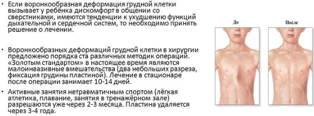 Деформация грудной клетки: виды, килевидная, вогнутая, врожденная, причины, лечение