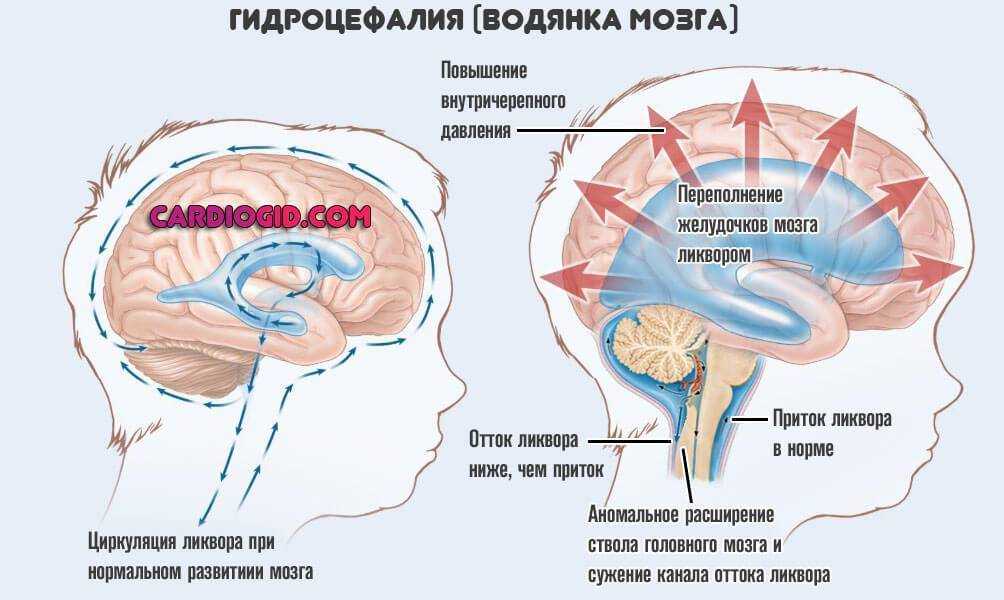 Шум в голове при внутричерепном давлении - причины, лечение