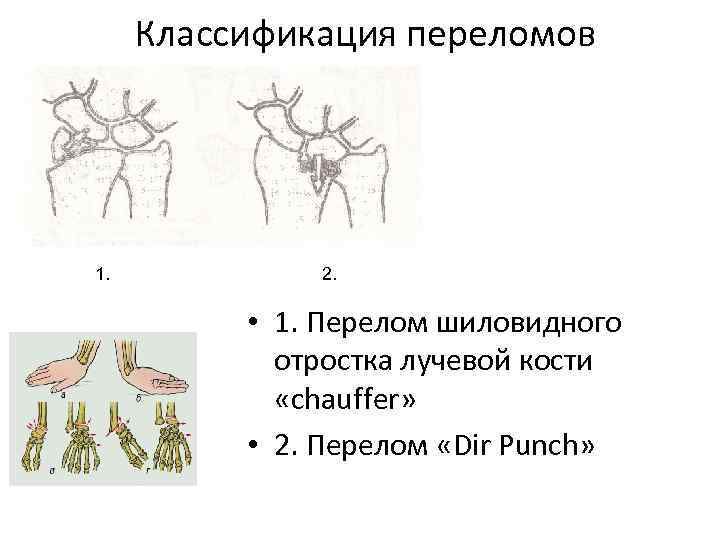 Лечение переломов лучевой кости