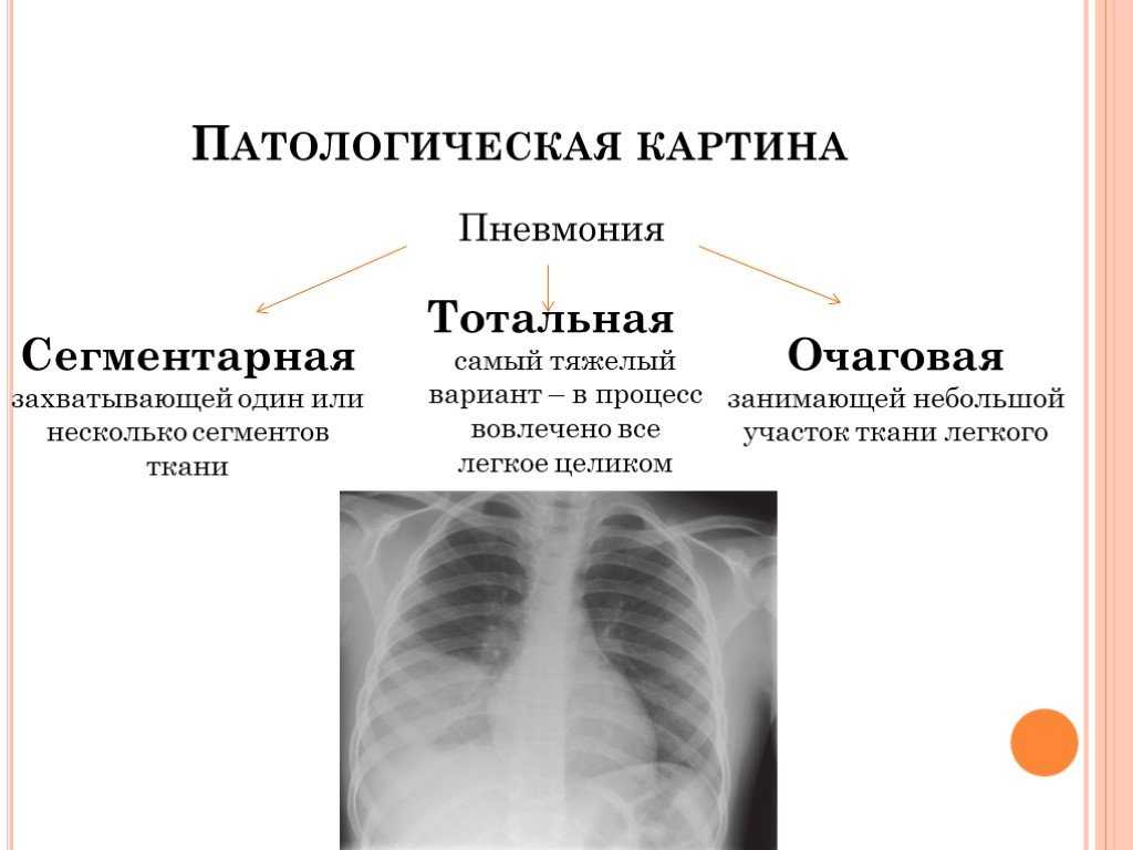 Сегментарная пневмония: характерные признаки