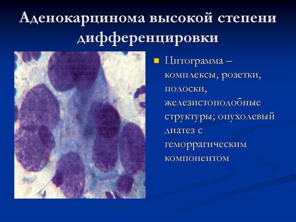 Низкодифференцированная карцинома | рак - лечение и профилактика