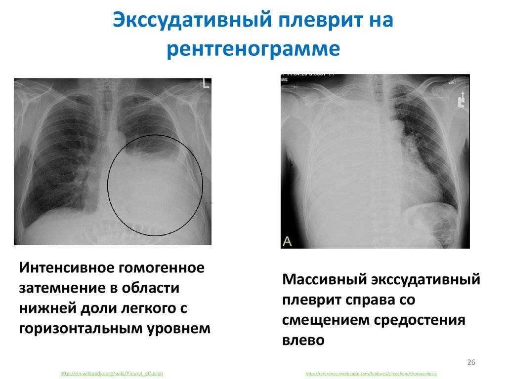Адгезивный плеврит: причины заболевания и особенности лечения | prof-medstail.ru