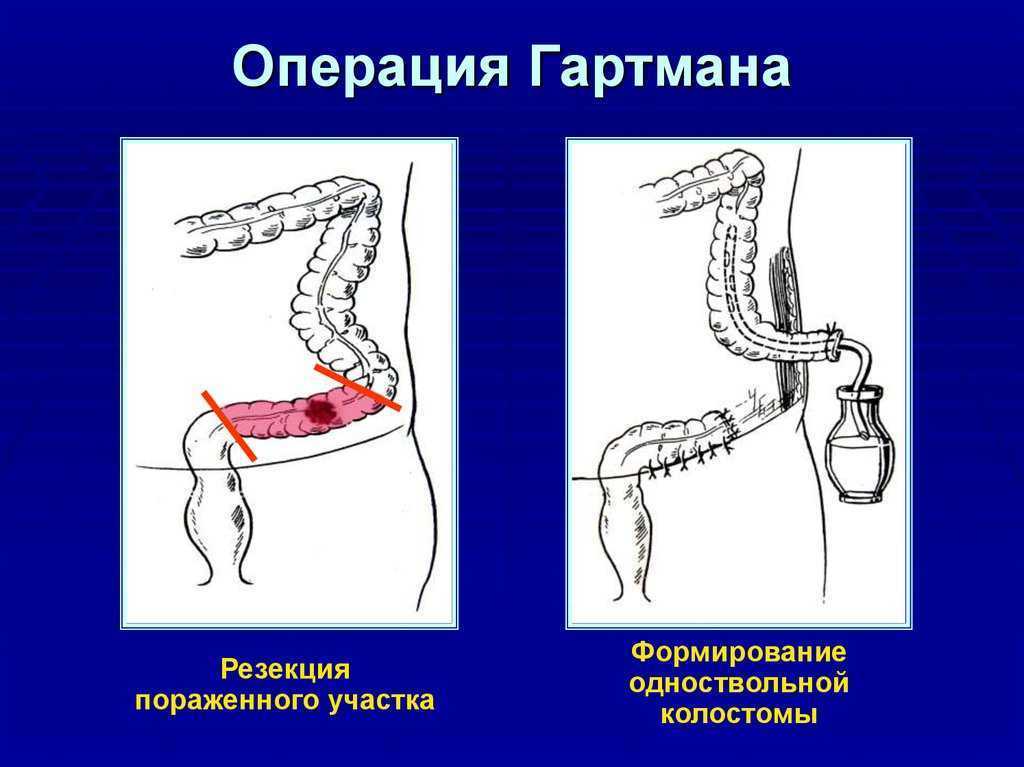 Панкреатодуоденальная резекция - константин олесьевич сёмаш
